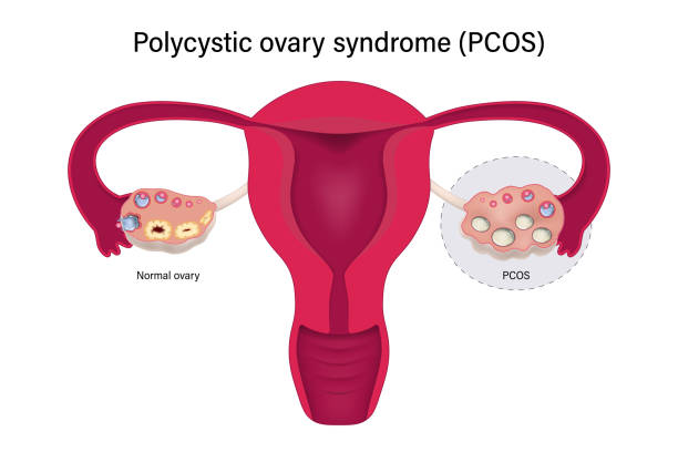 Best Doctor for Pcos & pcod treatment in Bhandup